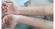 Có bắt buộc phải test da để thử phản ứng phản vệ khi đi tiêm thuốc?