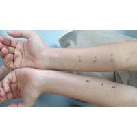 Có bắt buộc phải test da để thử phản ứng phản vệ khi đi tiêm thuốc?