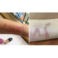 Tác nhân, nguồn lây truyền bệnh ấu trùng giun đũa chó/mèo theo Bộ Y tế?