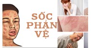 Sốc phản vệ là gì? Các triệu chứng nhận biết sốc phản vệ
