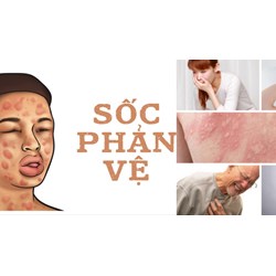 Sốc phản vệ là gì? Các triệu chứng nhận biết sốc phản vệ
