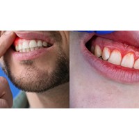 Nguyên tắc cần tuân thủ khi điều trị viêm quanh răng tiến triển chậm