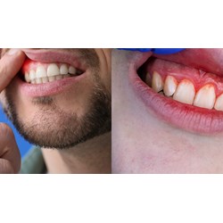 Nguyên tắc cần tuân thủ khi điều trị viêm quanh răng tiến triển chậm