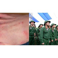 Viêm da cơ địa có phải tham gia nghĩa vụ quân sự hay không?