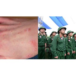 Viêm da cơ địa có phải tham gia nghĩa vụ quân sự hay không?