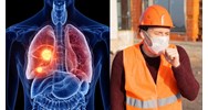 Người lao động làm các nghề, công việc nào có thể bị bệnh bụi phổi than?