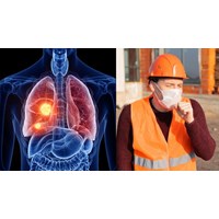 Người lao động làm các nghề, công việc nào có thể bị bệnh bụi phổi than?