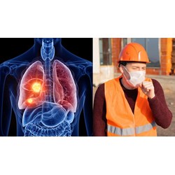 Người lao động làm các nghề, công việc nào có thể bị bệnh bụi phổi than?