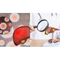 Bị nhiễm virus viêm gan B được làm những công việc nào theo quy định?