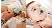 Quy định về thở oxy qua gọng mũi khi viêm phổi nặng ở trẻ sơ sinh?