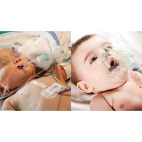 Quy định về thở oxy qua gọng mũi khi viêm phổi nặng ở trẻ sơ sinh?