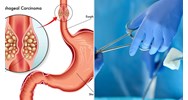 Thực hiện tạo hình thực quản bằng dạ dày không cắt thực quản chỉ định khi nào?