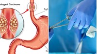 Thực hiện tạo hình thực quản bằng dạ dày không cắt thực quản chỉ định khi nào?