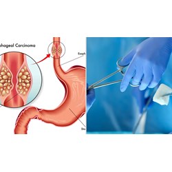 Thực hiện tạo hình thực quản bằng dạ dày không cắt thực quản chỉ định khi nào?
