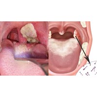 Người đang ở trong ổ dịch bạch hầu sẽ được điều trị như thế nào?