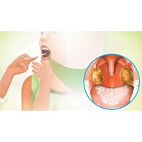 Dấu hiệu bệnh bạch hầu thanh quản ở người lớn được quy định ra sao?