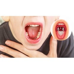 Nguyên tắc thực hiện việc phòng chống bệnh bạch hầu
