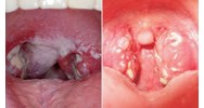Mức phạt tiền khi nhiễm bệnh bạch hầu nhưng không khai báo?