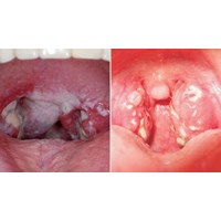 Mức phạt tiền khi nhiễm bệnh bạch hầu nhưng không khai báo?