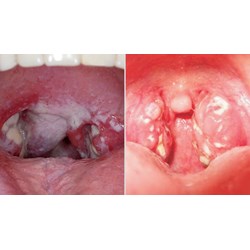 Mức phạt tiền khi nhiễm bệnh bạch hầu nhưng không khai báo?