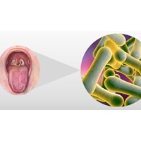 Triệu chứng của bệnh bạch hầu và Covid-19 khác nhau như thế nào?
