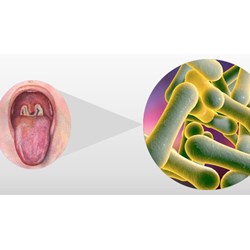 Triệu chứng của bệnh bạch hầu và Covid-19 khác nhau như thế nào?