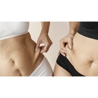 Quy định di truyền có phải là nguyên nhân gây bệnh béo phì không?
