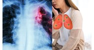 Các triệu chứng lao phổi giai đoạn đầu như thế nào?