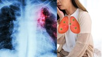 Các triệu chứng lao phổi giai đoạn đầu như thế nào?