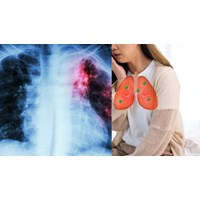 Các triệu chứng lao phổi giai đoạn đầu như thế nào?