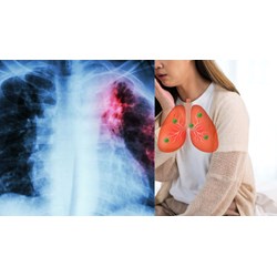 Các triệu chứng lao phổi giai đoạn đầu như thế nào?