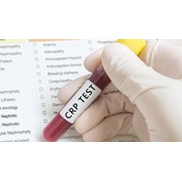 Crp là chỉ số gì? Crp bình thường là bao nhiêu?