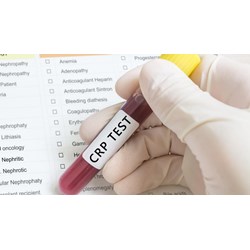 Crp là chỉ số gì? Crp bình thường là bao nhiêu?