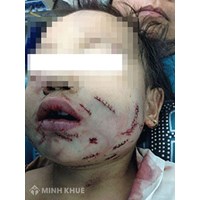 Không may để chó đẻ chạy ra đường cắn cô hàng xóm rách mặt, cụt tay thì chủ chó có phải bồi thường thiệt hại không ?