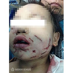 Không may để chó đẻ chạy ra đường cắn cô hàng xóm rách mặt, cụt tay thì chủ chó có phải bồi thường thiệt hại không ?