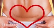 Chế độ dưỡng sức khi sinh mổ tính như thế nào?
