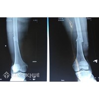 Bị gãy xương có được hưởng chế độ theo bảo hiểm xã hội không?
