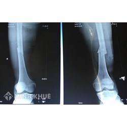 Bị gãy xương có được hưởng chế độ theo bảo hiểm xã hội không?