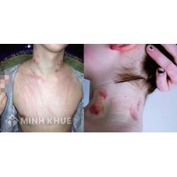 Xem xét dấu vết trên thân thể là gì? Thẩm quyền và nguyên tắc xem xét dấu vết trên thân thể và so sánh với biện pháp khám xét người