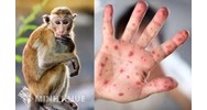 Bệnh đậu mùa khỉ là gì? Bệnh đậu mùa khỉ lây qua đường nào?