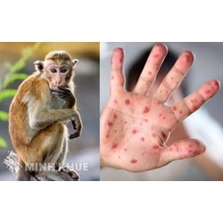 Bệnh đậu mùa khỉ là gì? Bệnh đậu mùa khỉ lây qua đường nào?