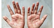 Hướng dẫn của Bộ Y tế trong chẩn đoán, điều trị và phòng bệnh đậu mùa khỉ ở người
