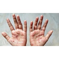 Hướng dẫn của Bộ Y tế trong chẩn đoán, điều trị và phòng bệnh đậu mùa khỉ ở người
