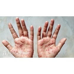 Hướng dẫn của Bộ Y tế trong chẩn đoán, điều trị và phòng bệnh đậu mùa khỉ ở người