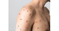 Các triệu trứng của bệnh đậu mùa khỉ? Các địa điểm khám bệnh đậu mùa khỉ