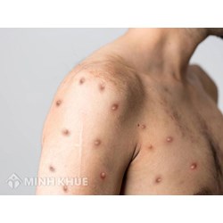 Các triệu trứng của bệnh đậu mùa khỉ? Các địa điểm khám bệnh đậu mùa khỉ