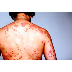 Một số chế độ chính sách mới cho người bị AIDS?