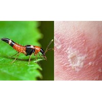 Bị kiến ba khoang cắn thì bôi thuốc gì?