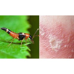 Bị kiến ba khoang cắn thì bôi thuốc gì?