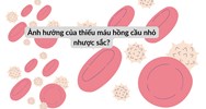 Ảnh hưởng của thiếu máu hồng cầu nhỏ nhược sắc?